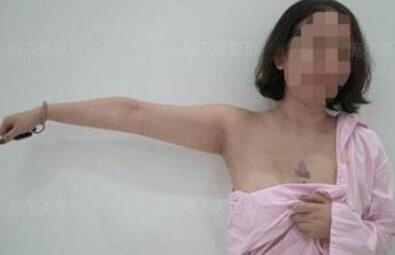 神奇的手臂吸脂術(shù)讓我對蝴蝶袖說再見|案例