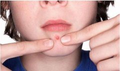 激光調(diào)節(jié)痤瘡之后會復(fù)發(fā)嗎？擔(dān)心痘痘反反復(fù)復(fù)