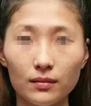 做自體脂肪填充臉部術(shù)后8天可以化妝嗎?