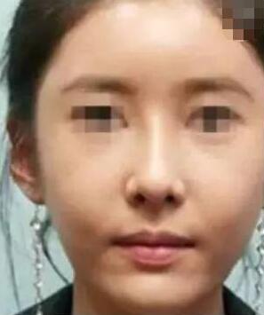 做自體脂肪填充臉部術(shù)后8天可以化妝嗎?