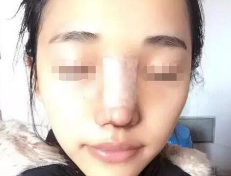 韓國ohkims整形外科醫(yī)院隆鼻案例