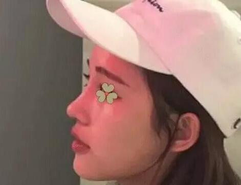 韓國ohkims整形外科醫(yī)院隆鼻案例