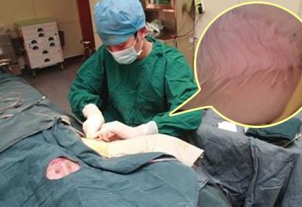 狐臭手術(shù)術(shù)后注意事項(xiàng)