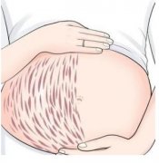 激光妊娠紋修復(fù)手術(shù)的價(jià)位！