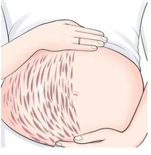 激光妊娠紋修復(fù)手術(shù)的價(jià)位！