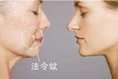 有法令紋的苦惱？哪些方法能夠消除法令紋？