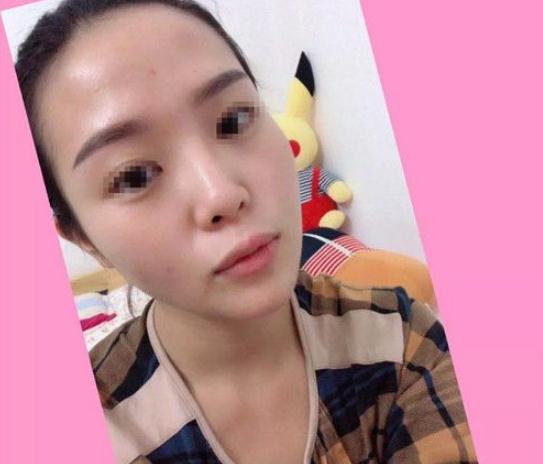 順德壹加壹做隆鼻手術(shù)術(shù)前