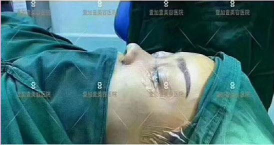 順德壹加壹做隆鼻手術(shù)術(shù)中