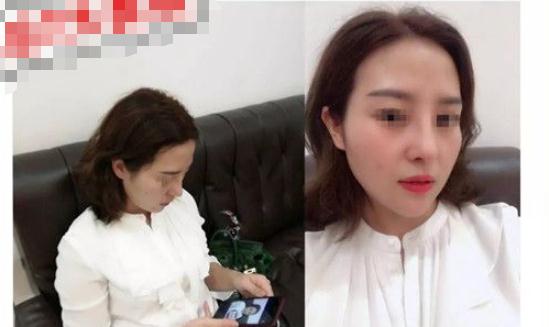 順德壹加壹做隆鼻手術(shù)術(shù)后一個(gè)月