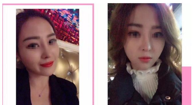 順德壹加壹做隆鼻手術(shù)術(shù)后三個(gè)月