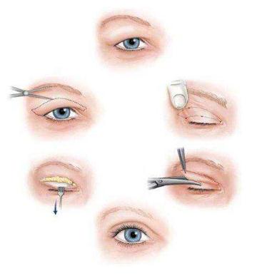雙眼皮失敗間隔多長時間能夠再次做?