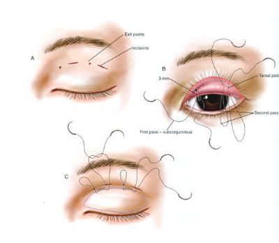 眼部手術(shù)一般多少錢?