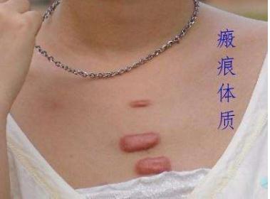 一般做瘢痕修復(fù)的手術(shù)的花費是多少？