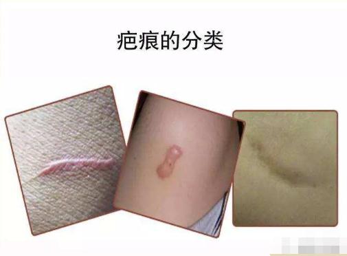 疤痕修復(fù)術(shù)后注意事項