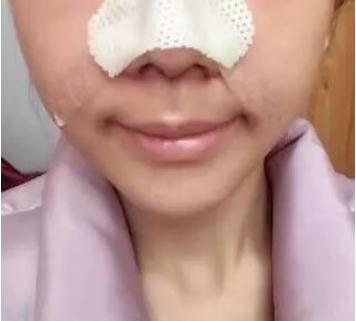 長(zhǎng)春假體隆鼻手術(shù)術(shù)后第3天