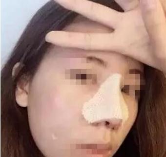 長(zhǎng)春假體隆鼻手術(shù)術(shù)后第7天