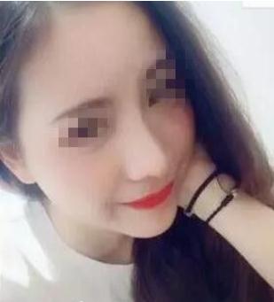 長(zhǎng)春假體隆鼻手術(shù)術(shù)后一個(gè)月