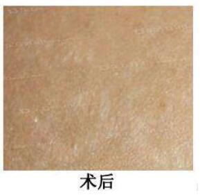 激光去除妊娠紋的果