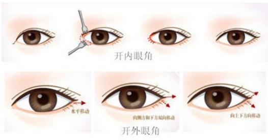 開眼角多久能恢復(fù)?