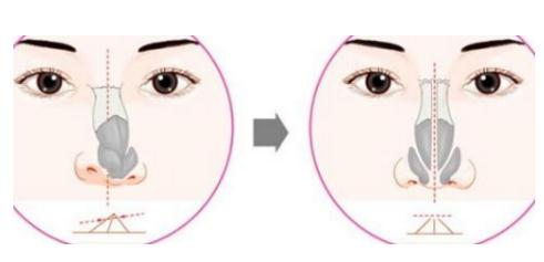 做歪鼻矯正手術(shù)CG高嗎？CG是多少？