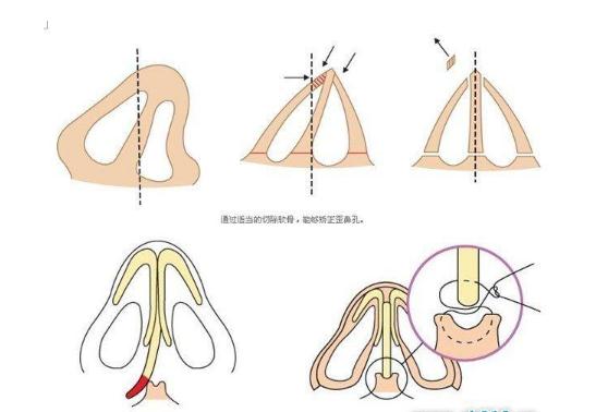 歪鼻矯正的CG是多少？