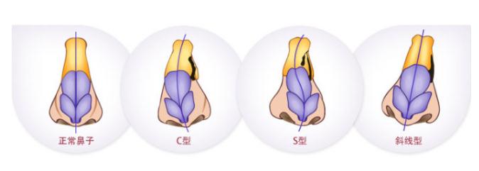 歪鼻子矯正的果是否自然？