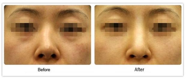 歪鼻子矯正的果是否自然？