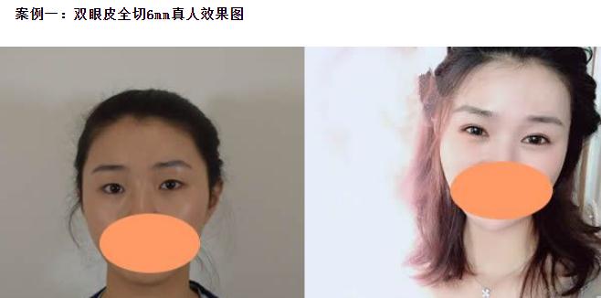 雙眼皮6 7 8毫米的區(qū)別，割雙眼皮多寬才好看？
