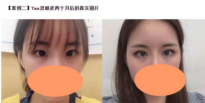 雙眼皮6 7 8毫米的區(qū)別，割雙眼皮多寬才好看？