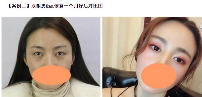 雙眼皮6 7 8毫米的區(qū)別，割雙眼皮多寬才好看？