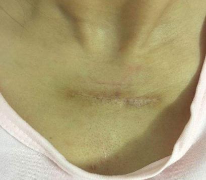 微瘢痕疙瘩需要調(diào)節(jié)?