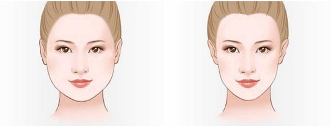 注射注射瘦臉后需要注意那些事項(xiàng)嗎?