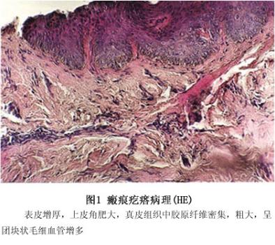 有瘢痕疙瘩怎么辦？該怎么調(diào)節(jié)？