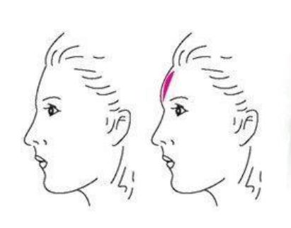 自體脂肪豐額的危害