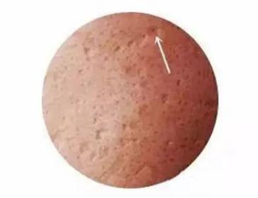 痘印產(chǎn)生的原因