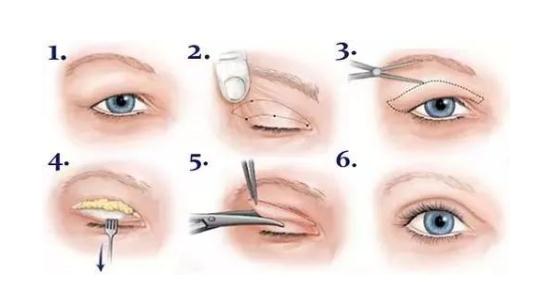 全切雙眼皮術(shù)后3個(gè)月可以做修復(fù)手術(shù)了嗎?