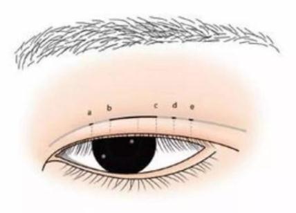 割完雙眼皮需要的注意事項(xiàng)