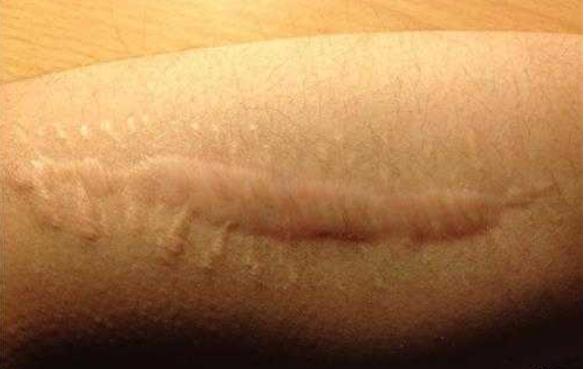 怎樣預(yù)防術(shù)后疤痕增生?