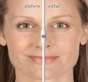 玻尿酸除皺的果好嗎?