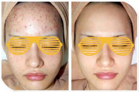 果酸煥膚調(diào)節(jié)痤瘡果怎么樣？