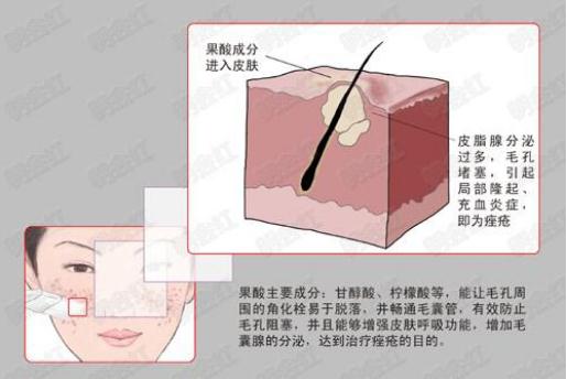 果酸煥膚調(diào)節(jié)痤瘡的方法