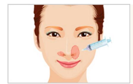 做玻尿酸除法令紋的果怎么樣?