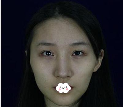 做顴骨內(nèi)推手術(shù)術(shù)前