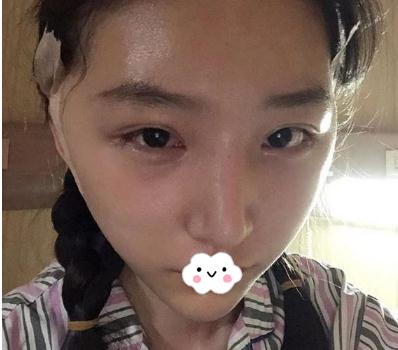 做顴骨內(nèi)推手術(shù)術(shù)后第5天