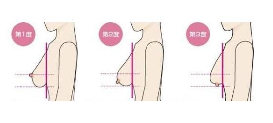 乳房懸吊手術(shù)