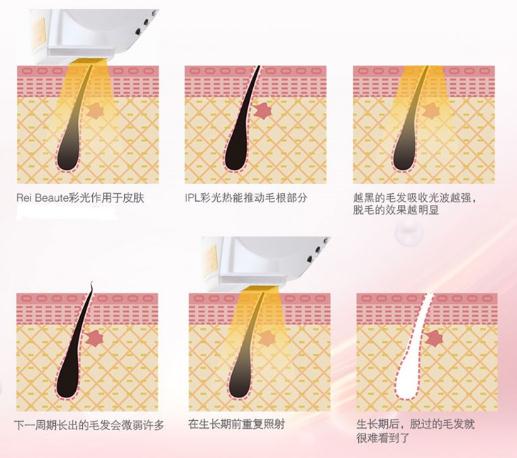 美容機(jī)構(gòu)去除腋毛的項目彩光脫毛