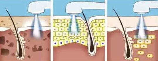 光子嫩膚的果好嗎?