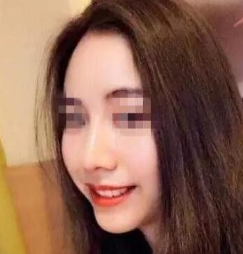 長(zhǎng)春假體隆鼻手術(shù)術(shù)后半年