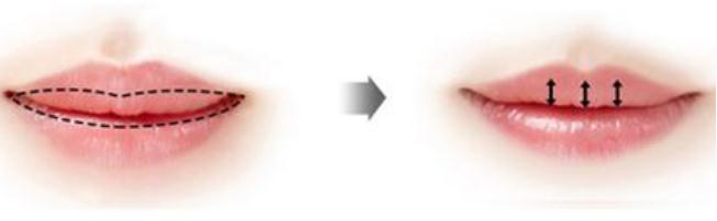 唇部整形的手術(shù)方式有哪些？怎么收費(fèi)的？
