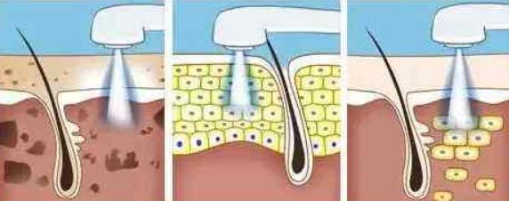 做光子嫩膚哪些不適合？禁忌人群